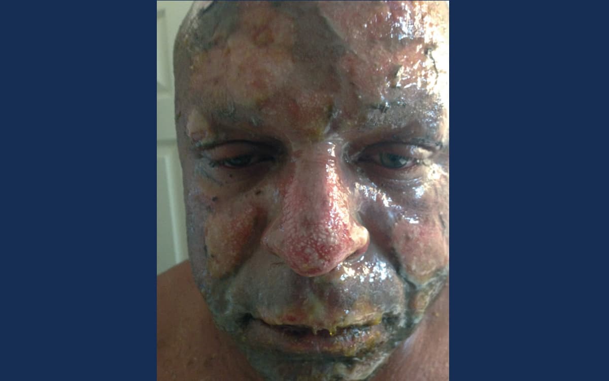 Before treatment