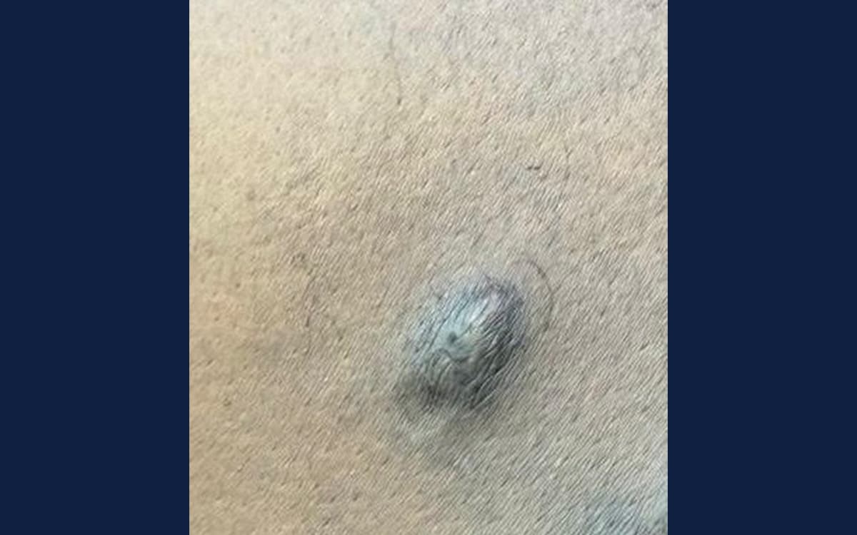 After treatment