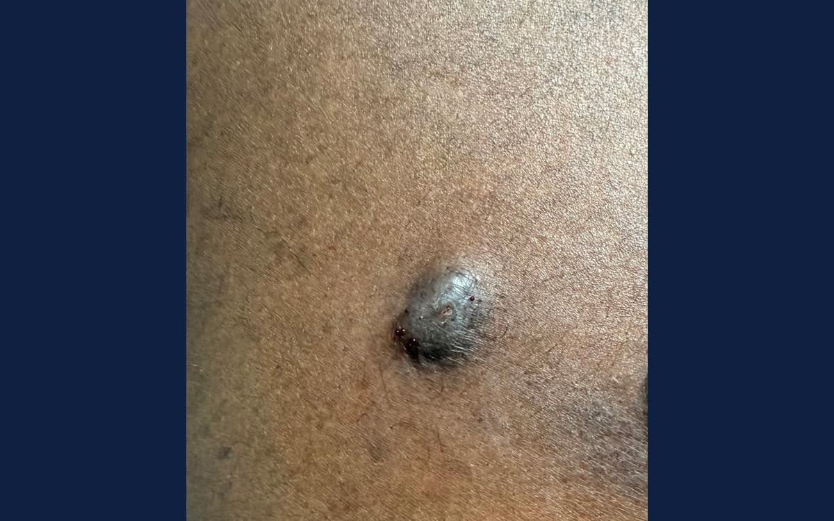 Before treatment