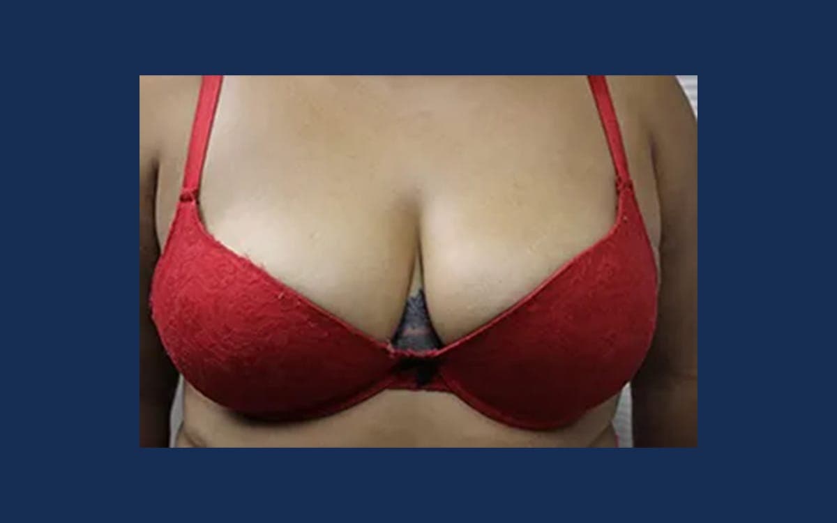 After treatment