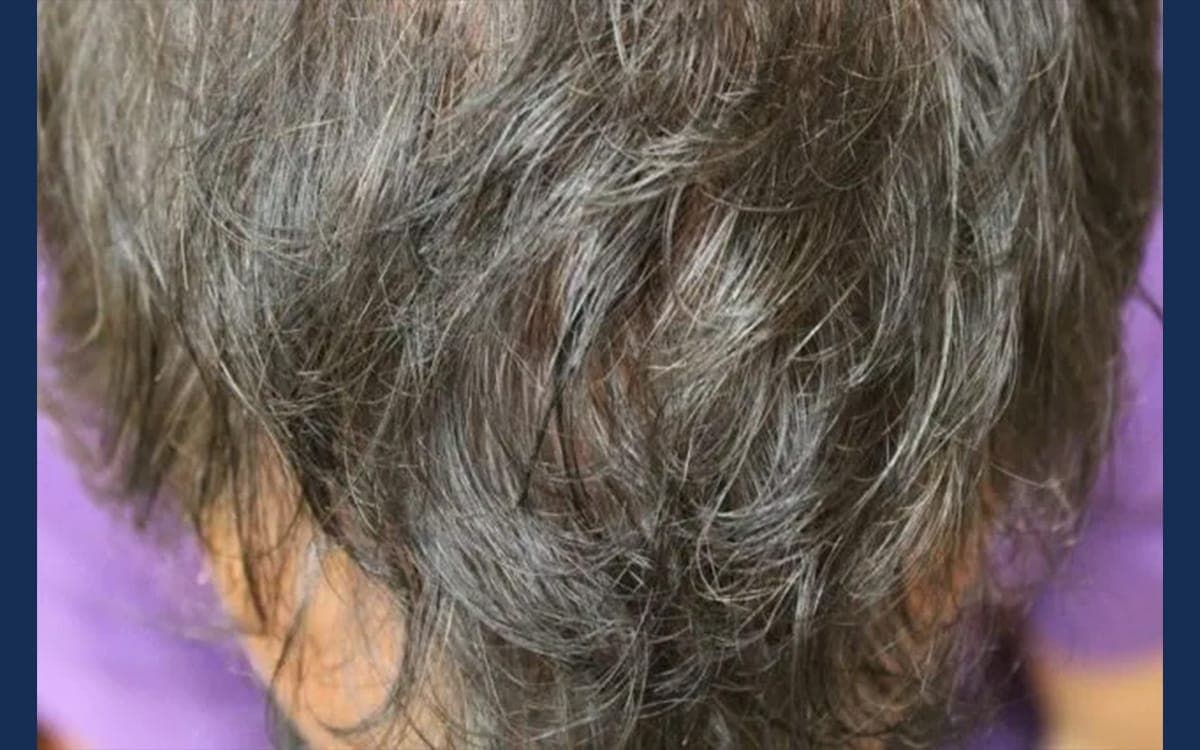 After treatment