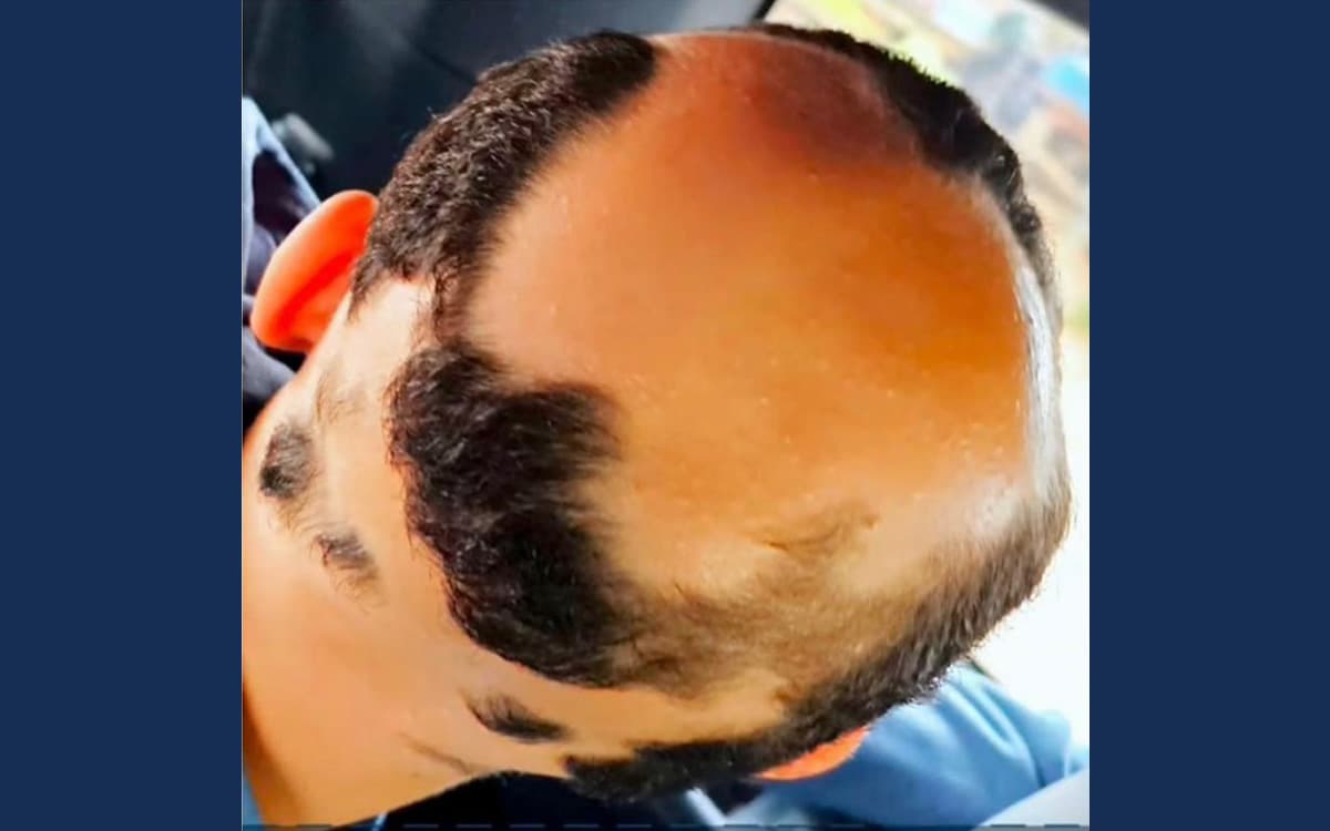 Before treatment