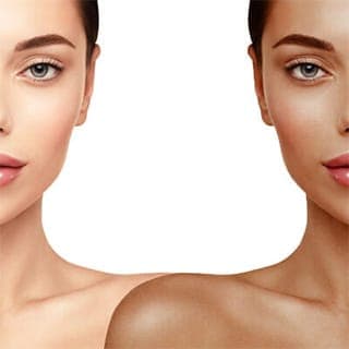 Dermal Fillers