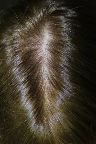 PRP Hair Restoration After-3