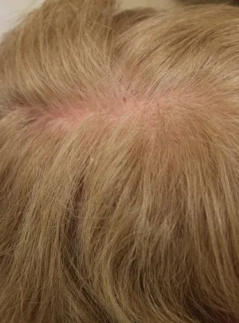 PRP Hair Restoration Before-2