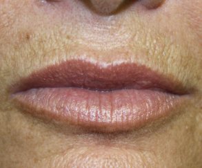 Lip Augmentation 1 - After Treatment