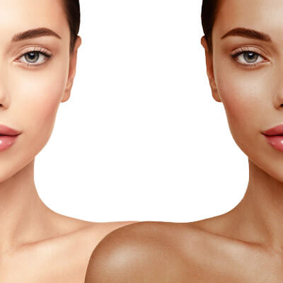 Dermal Filler Injections Tampa FL